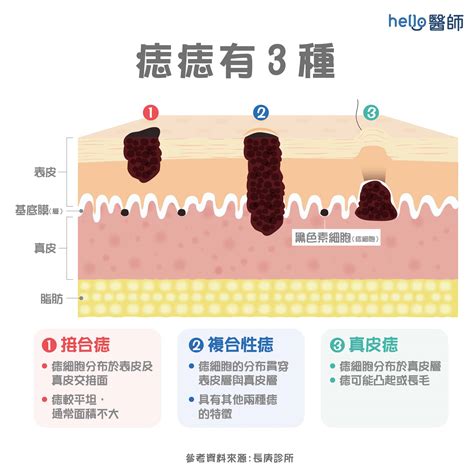 為什麼會長黑痣|為什麼臉上的痣越來越多？皮膚科醫師解析長痣原因、。